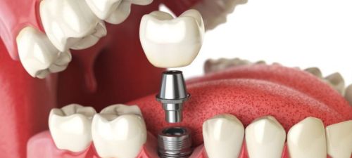 Dental Implant Ilford