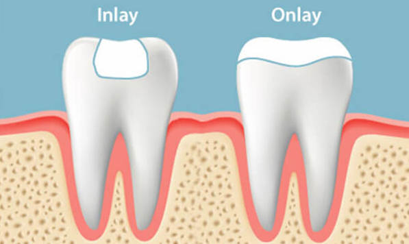 Dental Inlay Essex