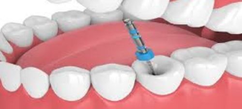 Root Canal Essex