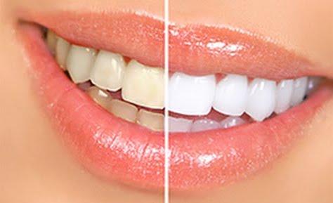 Teeth Whitening Ilford