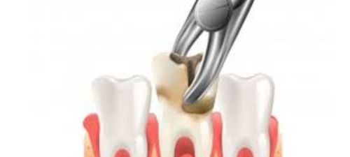 Tooth Extraction Essex
